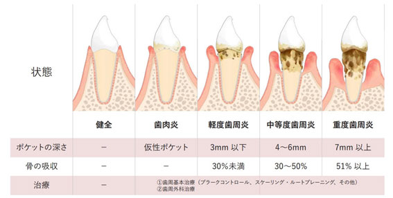 歯周病3